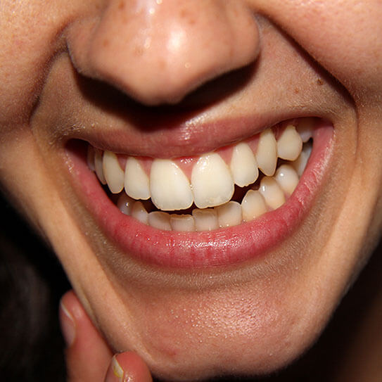 Implicat in medie kilometri  What Are Those White Spots On My Teeth? - Greenway Smiles